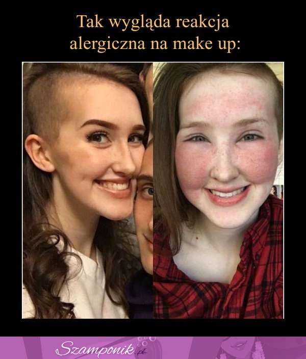 Zastanawiałaś się jak wygląda REAKCJA ALERGICZNA na make-up! To zobacz koniecznie tą dziewczynę, SZOK!