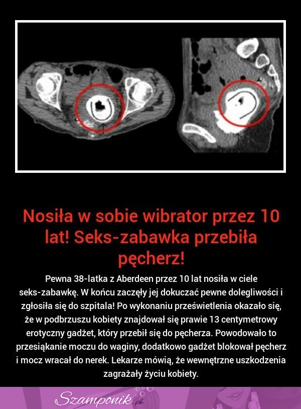 SZOK! Nosiła w sobie WIBRATOR przez 10 LAT! Musisz koniecznie to zobaczyć!