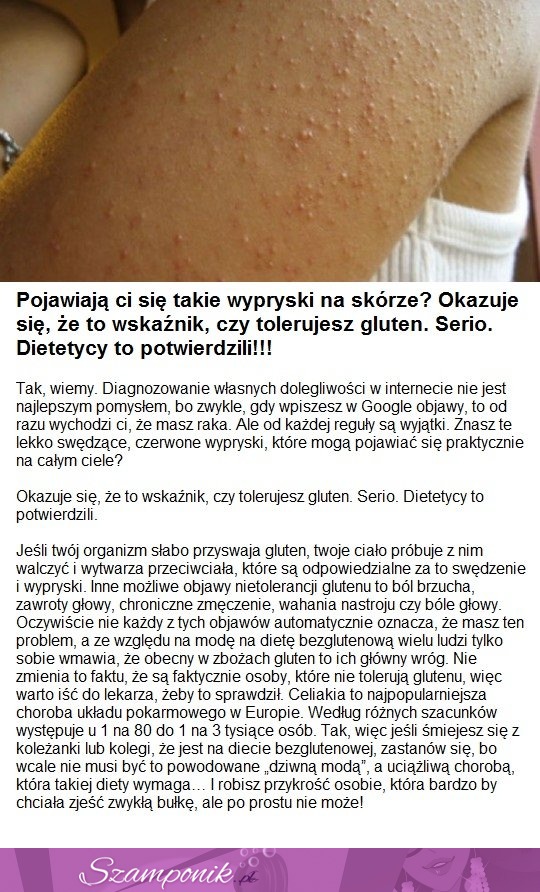 Pojawiają Ci się takie wypryski na skórze? Okazuje się, że to wskaźnik, czy tolerujesz gluten!