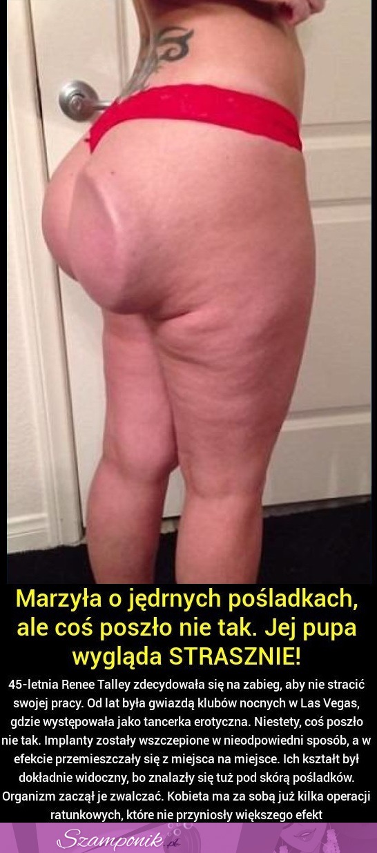 Marzyła o jędrnych pośladkach ale coś poszło nie tak - Jej pupa wygląda strasznie! FUU!