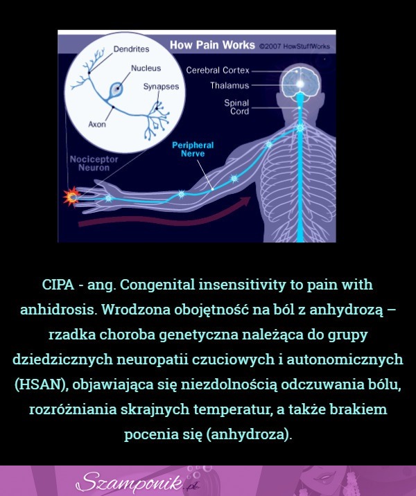 Rzadka choroba genetyczna... Zobacz czym się objawia!