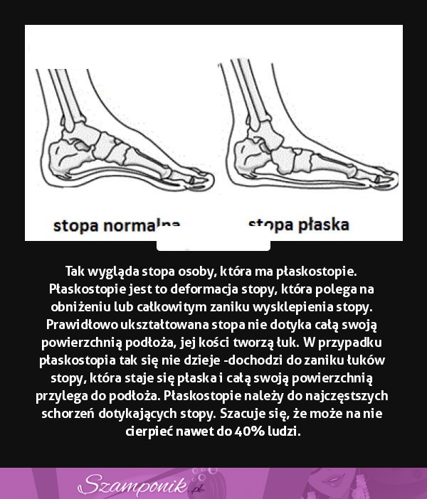 Tak wygląda stopa osoby, która ma płaskostopie...