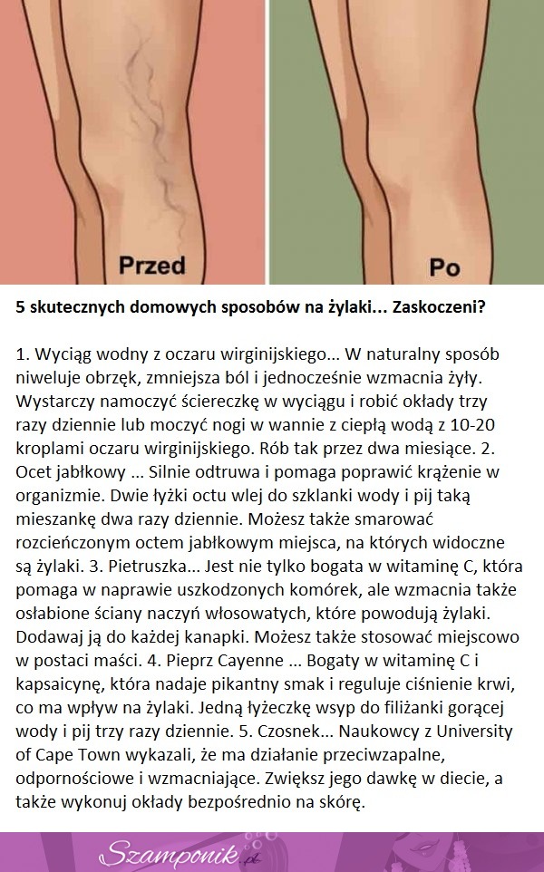 5 skutecznych domowych sposobów na żylaki... Zaskoczeni?