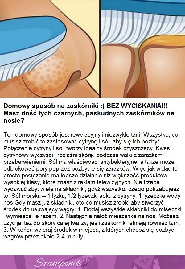 Domowy sposób na zaskórniki BEZ WYCISKANIA!