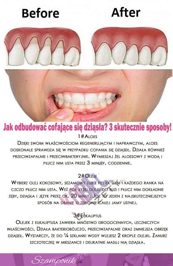 Jak odbudować cofające się dziąsła? 3 skuteczne sposoby!