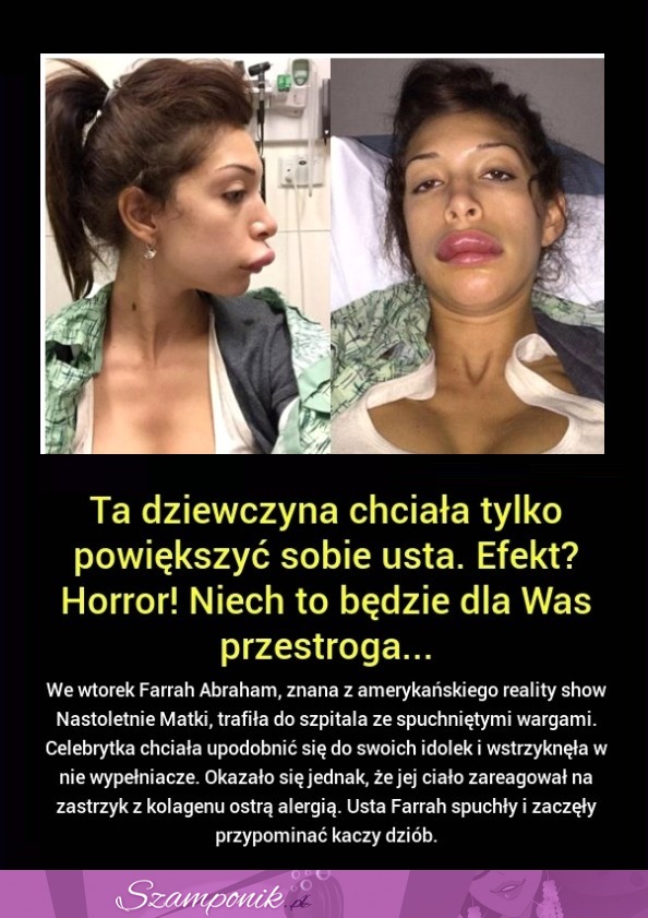 Ta DZIEWCZYNA chciała POWIĘKSZYĆ sobie USTA! Wygląda jak z HORRORU!