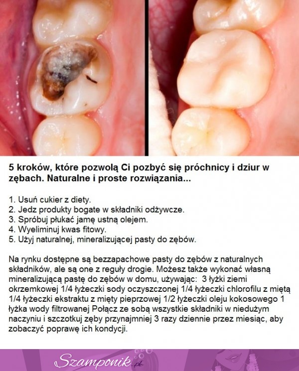 5 kroków, które pozwolą Ci pozbyć się próchnicy i dziur w zębach. Naturalne i proste rozwiązania...