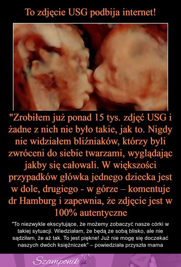 To zdjęcie USG podbija internert! Lekarz w szoku...