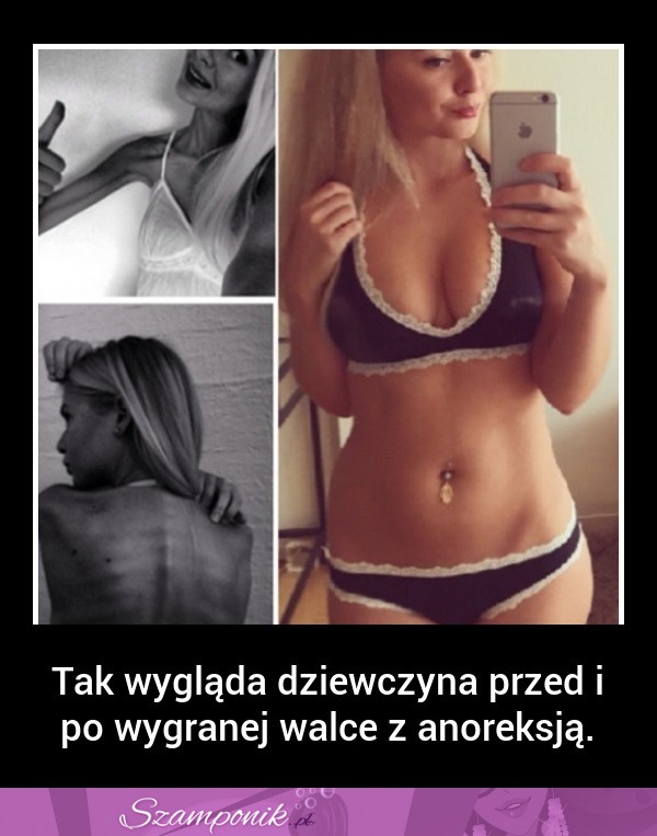 WOW! Ta dziewczyna wyszła z ANOREKSJI! Zobacz jak teraz wygląda!