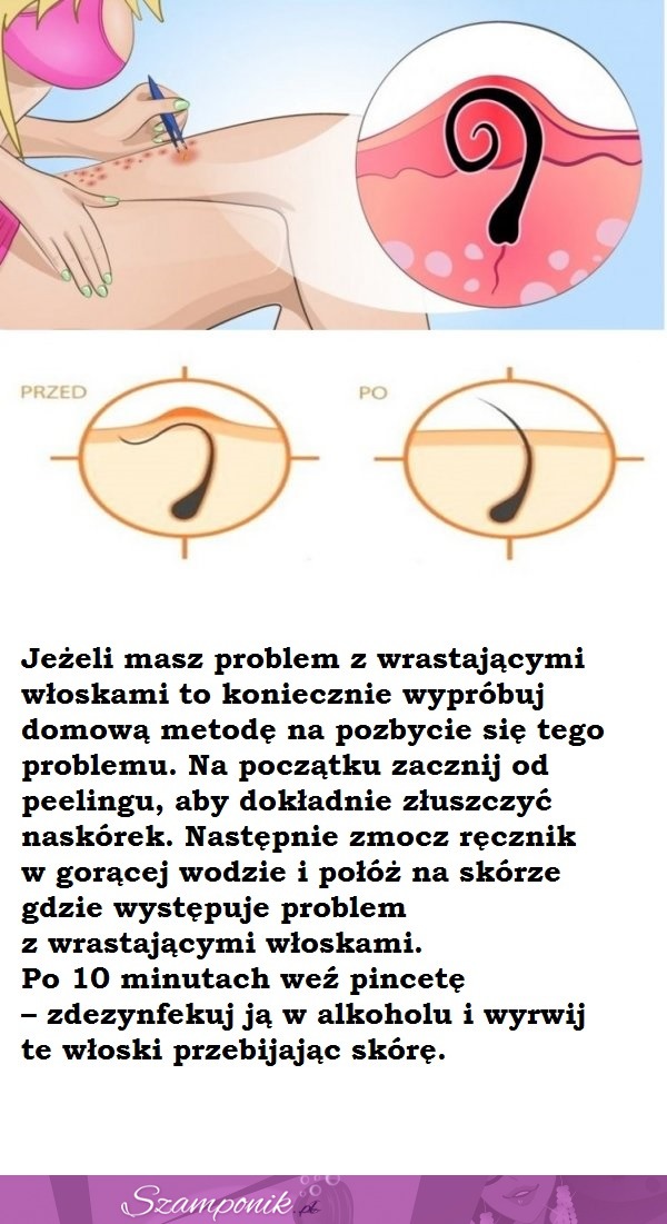 Domowa metoda na wrastające włoski!