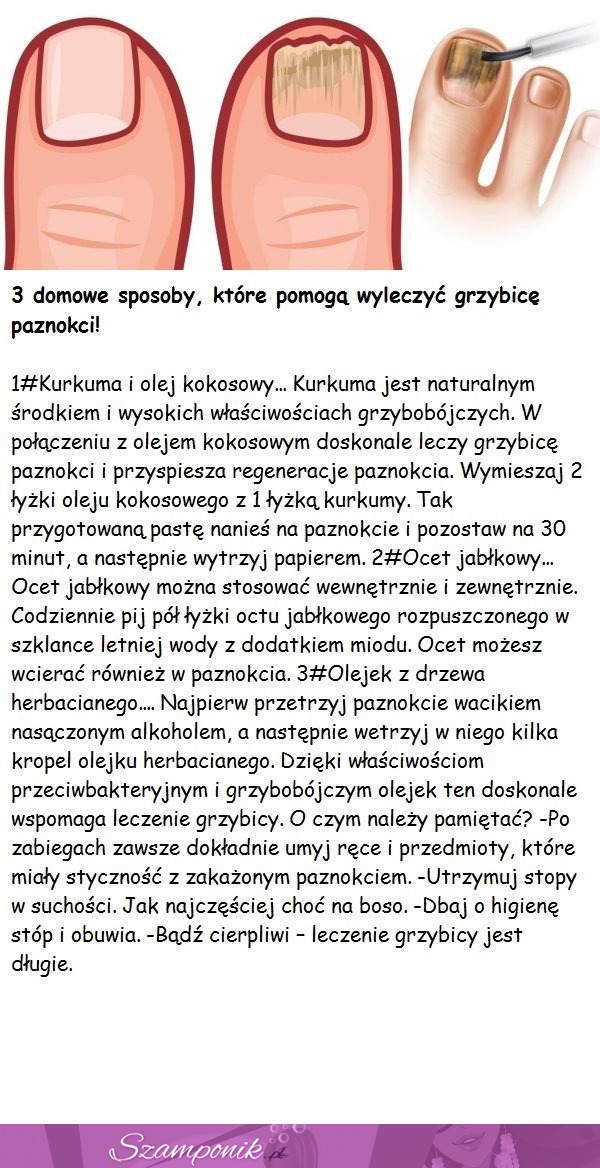 3 domowe sposoby, które pomogą wyleczyć grzybicę paznokci