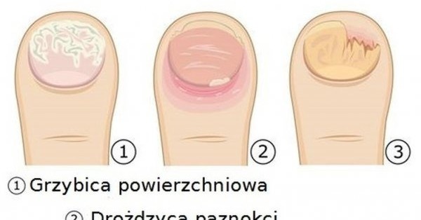 - 3 rodzaje grzybicy paznokci 