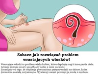 Zobacz, jak rozwiązać PROBLEM wrastających włosków! MEGA!