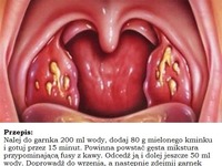 Jak POZBYĆ SIĘ powiększonych migdałków i bólu gardła w ciągu zaledwie KILKU godzin!