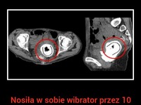 SZOK! Nosiła w sobie WIBRATOR przez 10 LAT! Musisz koniecznie to zobaczyć!