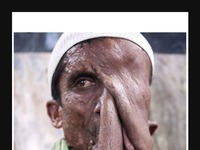 Ten mężczyzna cierpi na STRASZNĄ chorobę, która powoduje, że jego twarz wygląda jakby się topiła