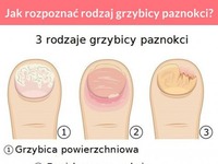 Jak rozpoznać rodzaj grzybicy paznokci? - 3 rodzaje grzybicy paznokci