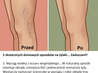 5 skutecznych domowych sposobów na żylaki... Zaskoczeni?