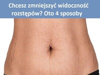 Chcesz zmniejszyć widoczność rozstępów? Oto 4 sposoby!