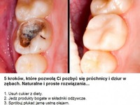 5 kroków, które pozwolą Ci pozbyć się próchnicy i dziur w zębach. Naturalne i proste rozwiązania...