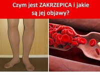 Czym jest ZAKRZEPICA i jakie są jej objawy?