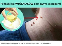 Pozbądź się włókniaków domowym sposobem!