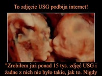 To zdjęcie USG podbija internert! Lekarz w szoku...