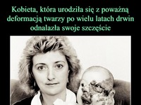 Kobieta, która urodziła się z poważną deformacją twarzy po wielu latach drwin odnalazła swoje szczęście!