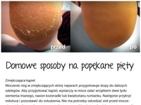 Domowe SPOSOBY na popękane stopy... To DZIAŁA!