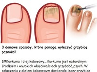 3 domowe sposoby, które pomogą wyleczyć grzybicę paznokci